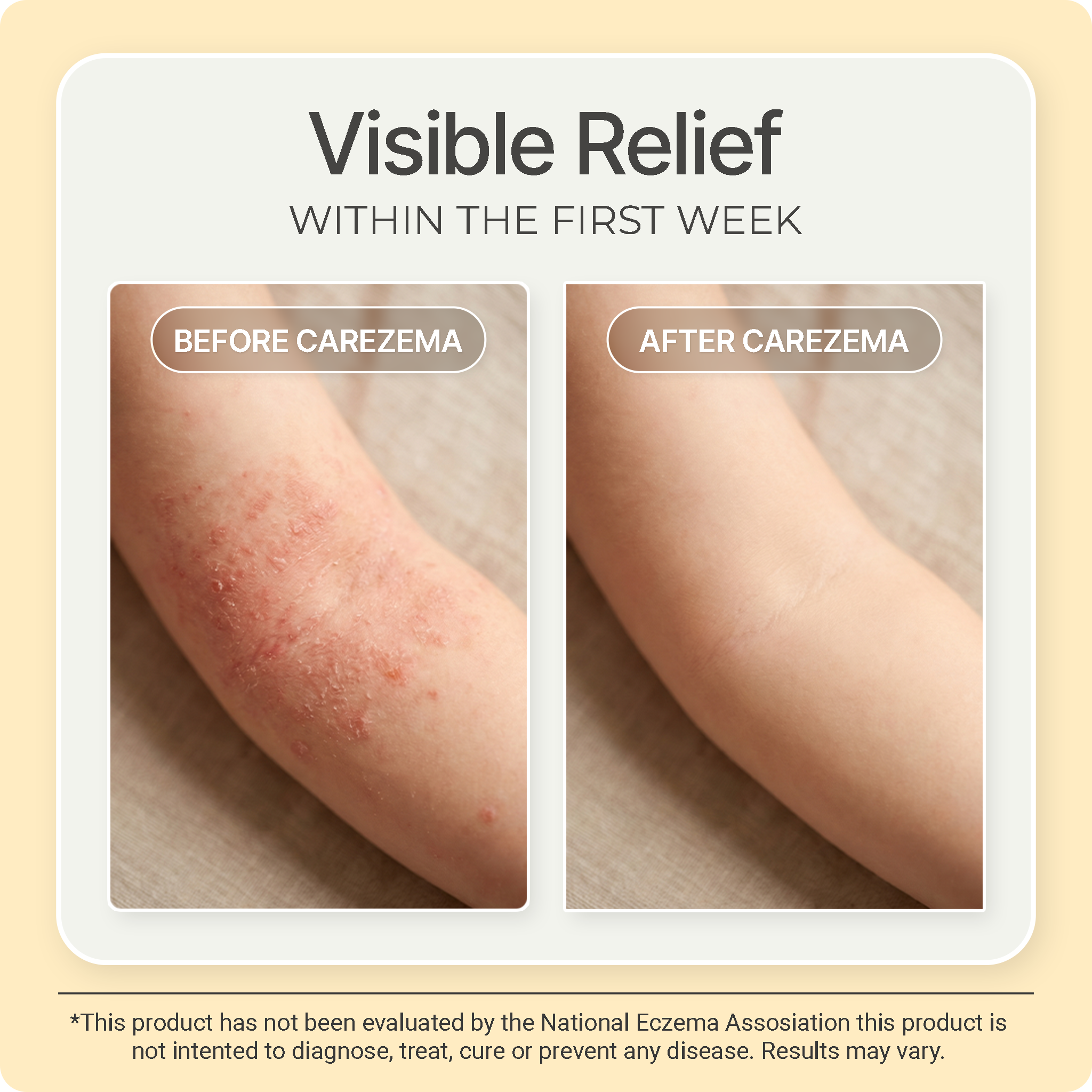 Carezema Eczema Soothing Honey