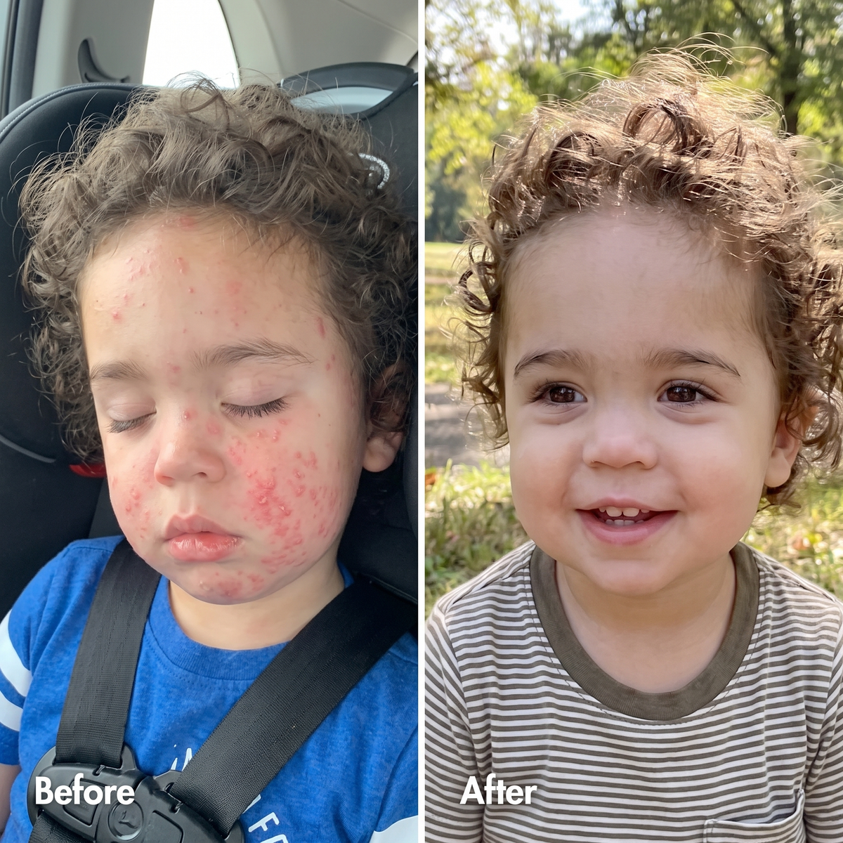 Carezema Eczema Honey
